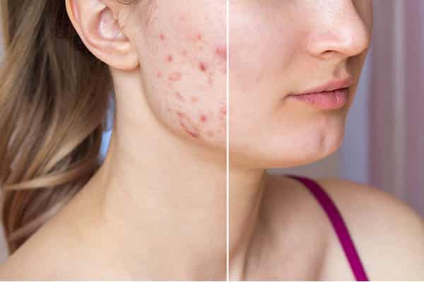 Before attempting to treat your acne with a chemical peel, microdermabrasion, or laser therapy, consult a physician