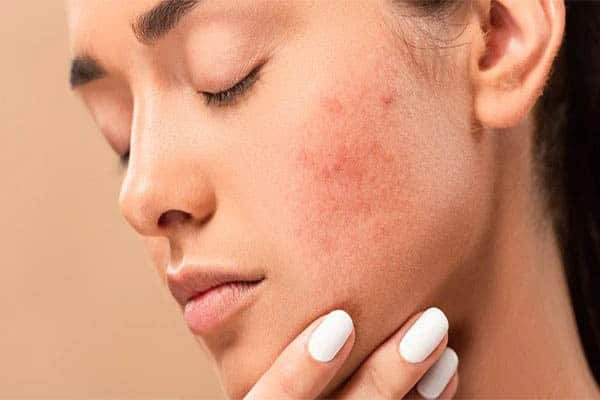  Acne-prone skin