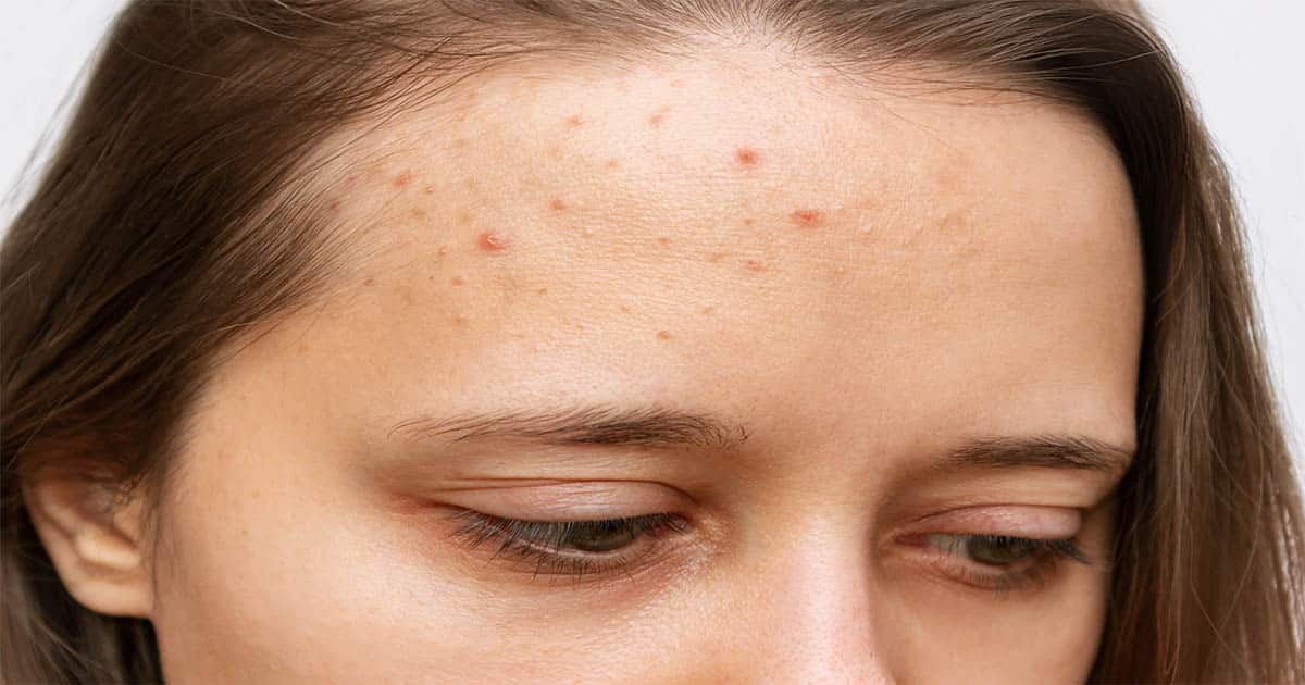 Natural Pimple and Acne Treatments