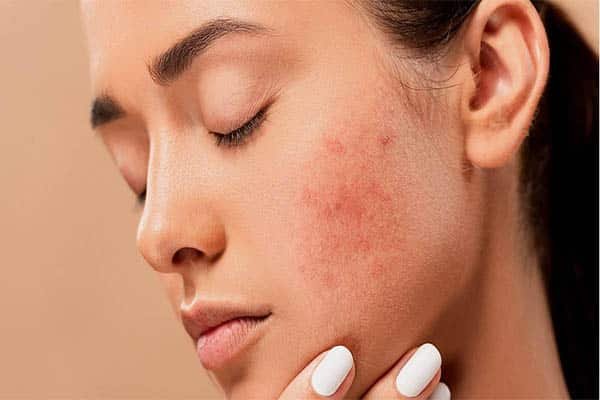 Only your blemishes should receive acne medication