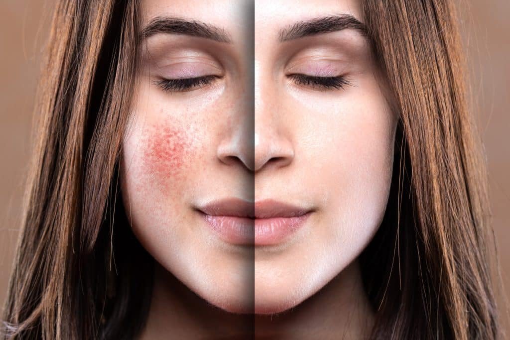  Rosacea Treatment